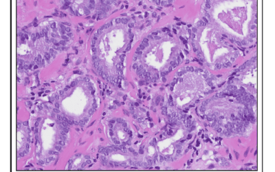 Prostate Cancer and GU Pathology 2nd Opinions
